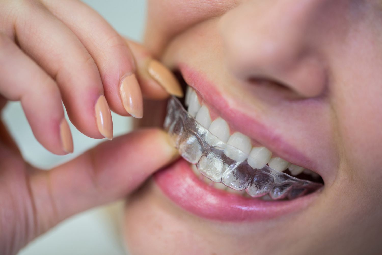 Orthodontics (Braces & Aligners)
