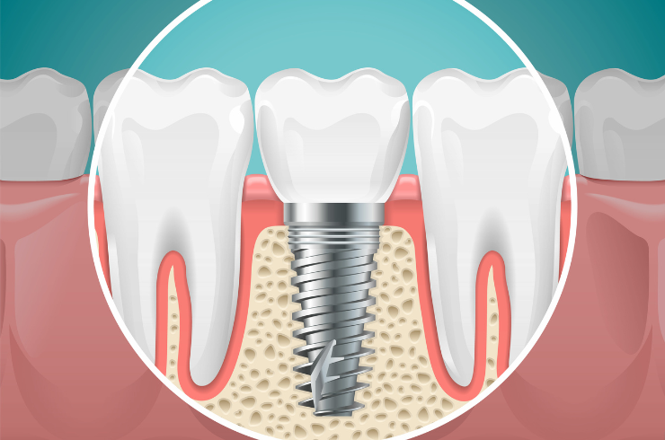 Dental Implants