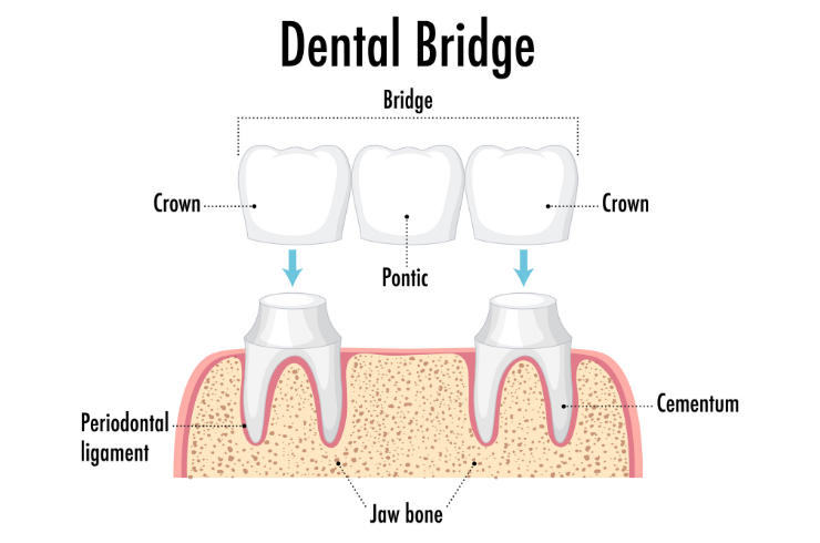 Dental Crowns & Bridges